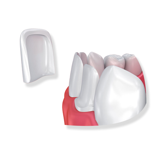 Керамическая реставрация зубов