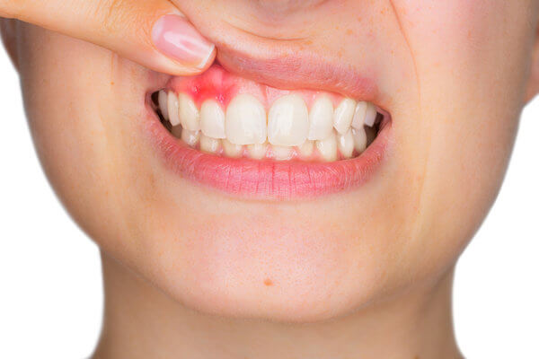 Лечение кисты в десне зуба