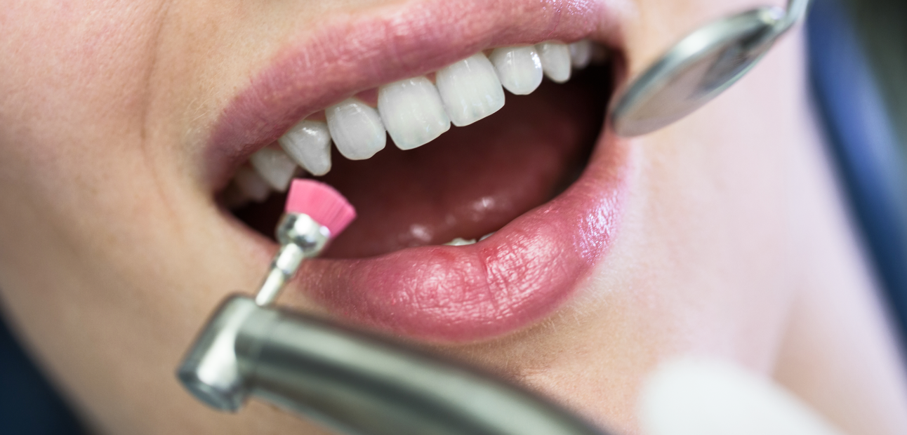 Гигиена полости рта «Smokie» со скидкой 47% - стоматологический центр Империя