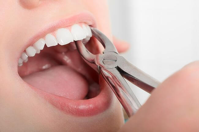 Лечение десны после удаления зуба