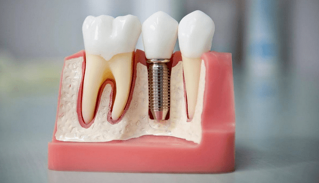 Может ли болеть имплант зуба