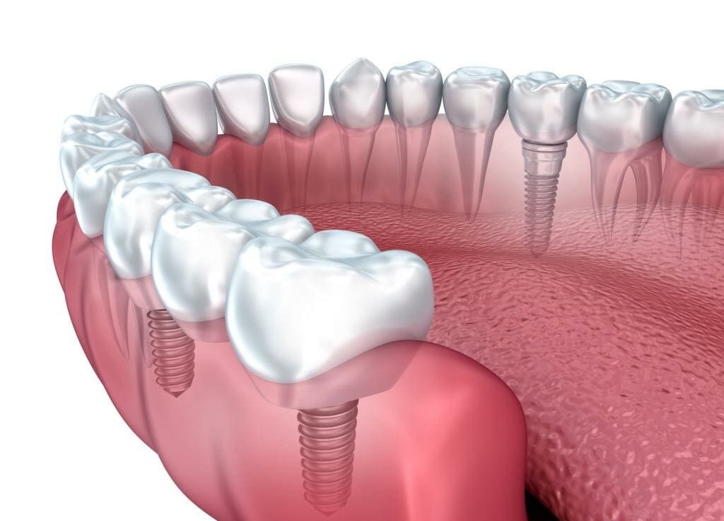 Как приживается имплант зуба