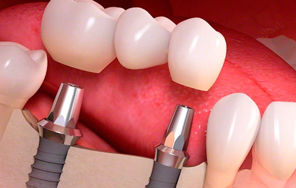 Как приживается имплант зуба