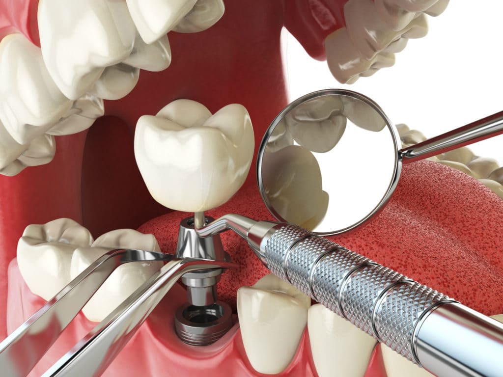 Выпадают импланты зубов: причины и решения