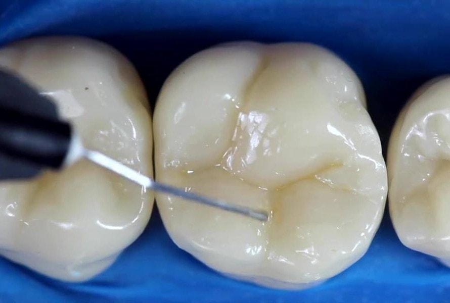 Пломбирование молочных зубов Томск Сплавной 3-й стоматология томск цены недорого