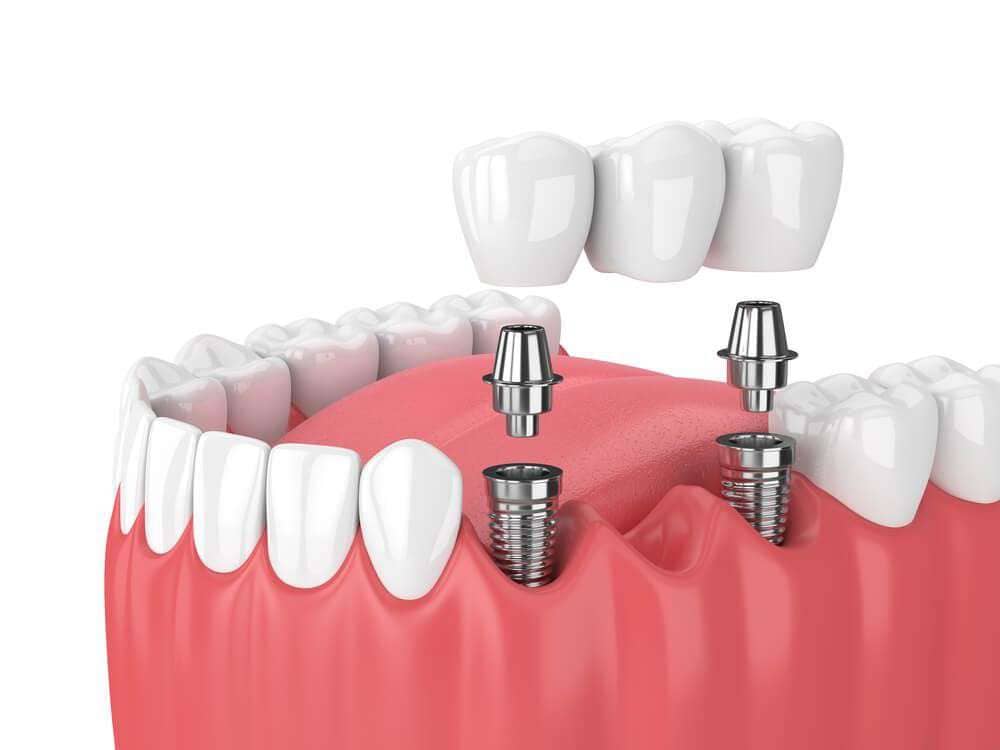 Рейтинг имплантов зубов
