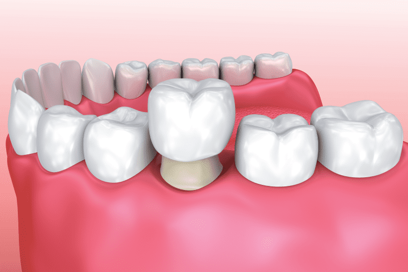 Как делают реставрацию зубов 