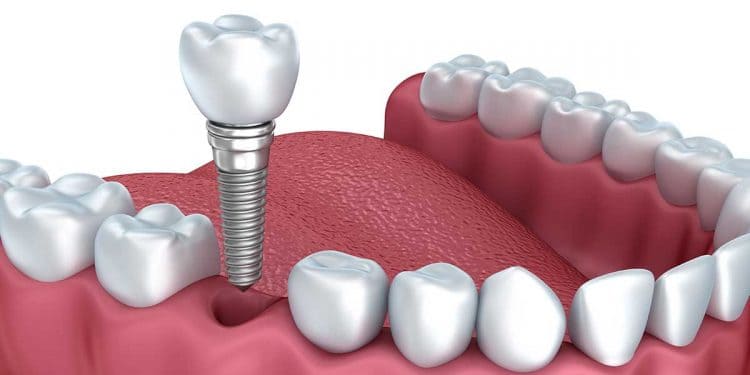 Выпадают импланты зубов: причины и решения