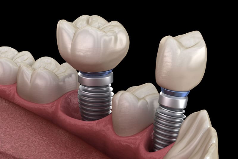 Способы протезирования зубов