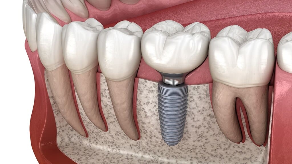 Имплантация после удаления зуба с кистой