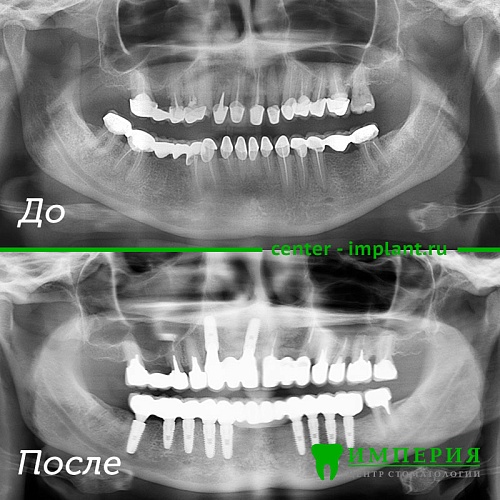Имплантация 1 зуба 