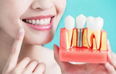 Имплантация зубов - Центр стоматологии Империя